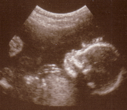 AlessandraSwooning.jpg - I'm swooning in all this amniotic fluid. Mom, go eat a Krispy Kream.